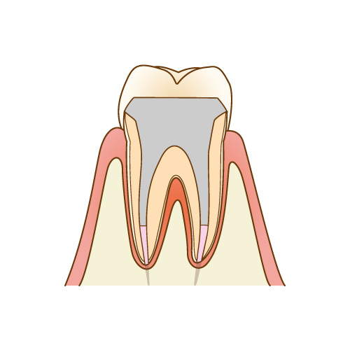 根管充填と被せ物（クラウン）の装着と、治療後の経過観察