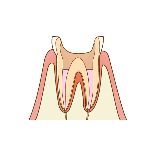 根管充填と被せ物（クラウン）の装着と、治療後の経過観察