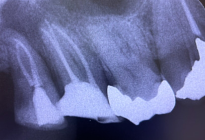歯科用CTによる治療精度の向上と時間短縮