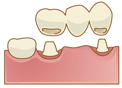 入れ歯やブリッジとの比較