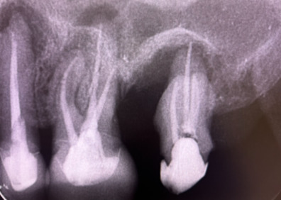 歯科用CTによる治療精度の向上と時間短縮