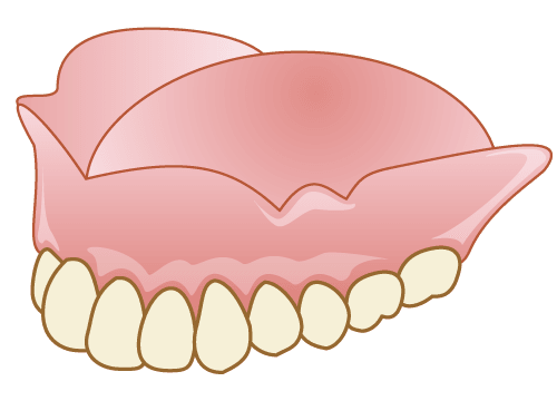 入れ歯やブリッジとの比較
